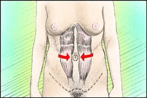 Abdominoplasti - Vücut Şekillendirme
