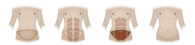 Abdominoplasti - Vücut Şekillendirme